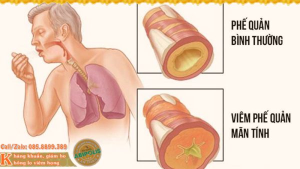 4 Bài thuốc chữa viêm phế quản mạn tính dễ làm tại nhà