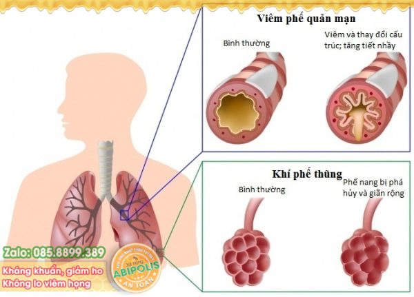 Tìm ra căn nguyên gây bệnh viêm đường hô hấp mạn tính