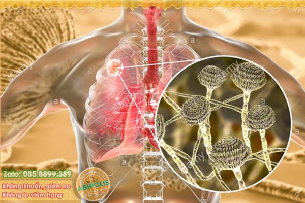 Bệnh nấm phổi, những vấn đề cơ bản cần biết