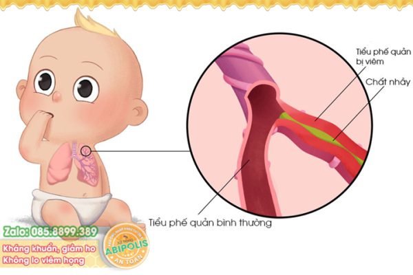 Viêm tiểu phế quản ở trẻ em, bệnh không thể xem thường