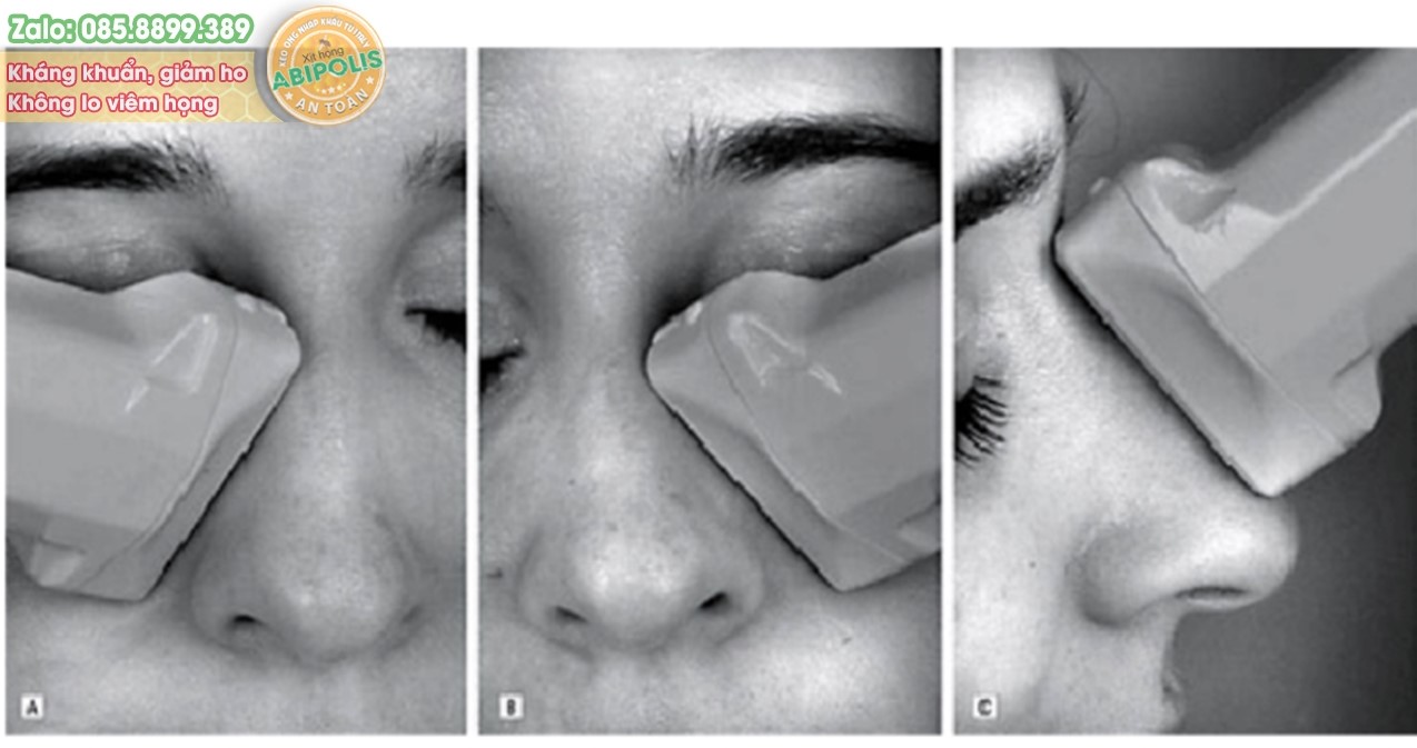 Giải pháp mới điều trị viêm mũi xoang mạn tính với sóng siêu âm