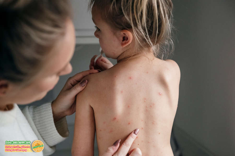 Hà Nội: Số ca mắc bệnh thủy đậu tiếp tục tăng nhanh