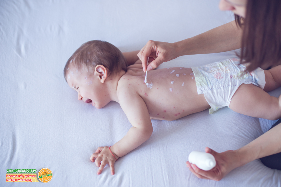 Hà Nội: Số ca mắc bệnh thủy đậu tiếp tục tăng nhanh