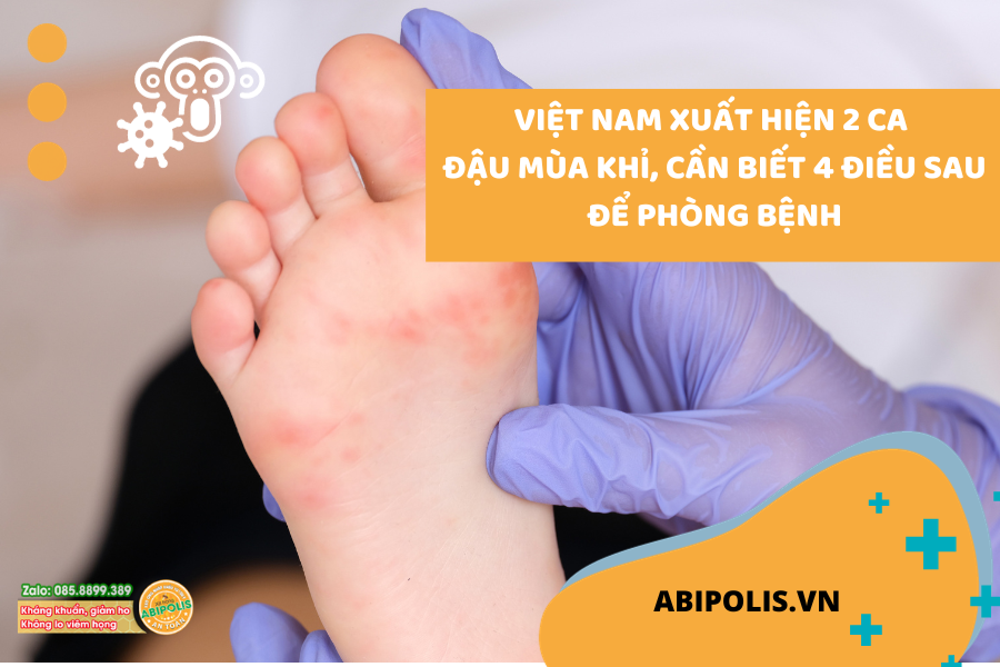 VIỆT NAM XUẤT HIỆN 2 CA ĐẬU MÙA KHỈ, CẦN BIẾT NHỮNG ĐIỀU SAU ĐỂ PHÒNG BỆNH