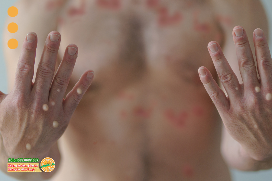 VIỆT NAM XUẤT HIỆN 2 CA ĐẬU MÙA KHỈ, CẦN BIẾT NHỮNG ĐIỀU SAU ĐỂ PHÒNG BỆNH